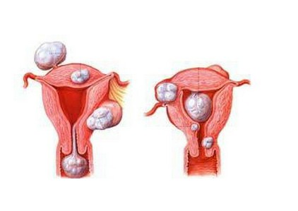 子宫肌瘤多大需要做手术